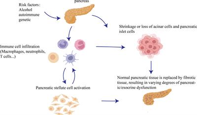 Immune cells and immune cell-targeted therapy in chronic pancreatitis